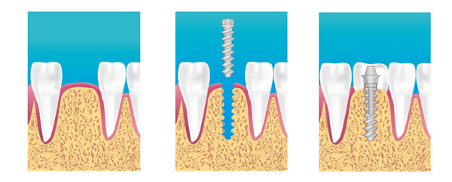 implant dentaire Dentiste Nantes